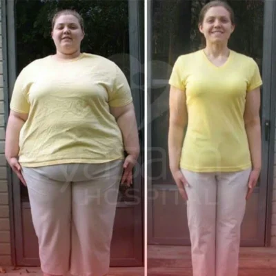 Gastric Sleeve