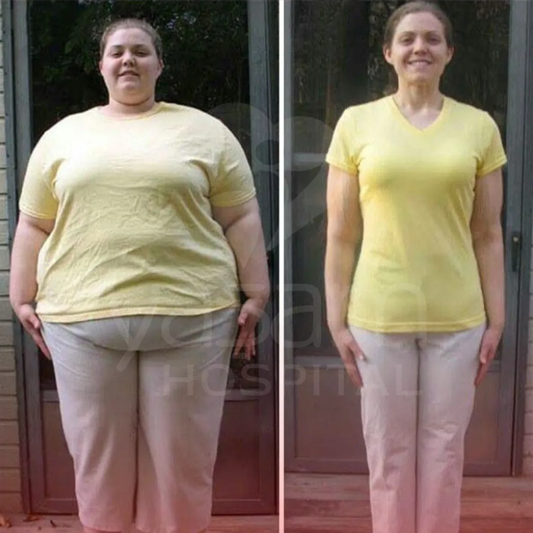 GASTRIC SLEEVE