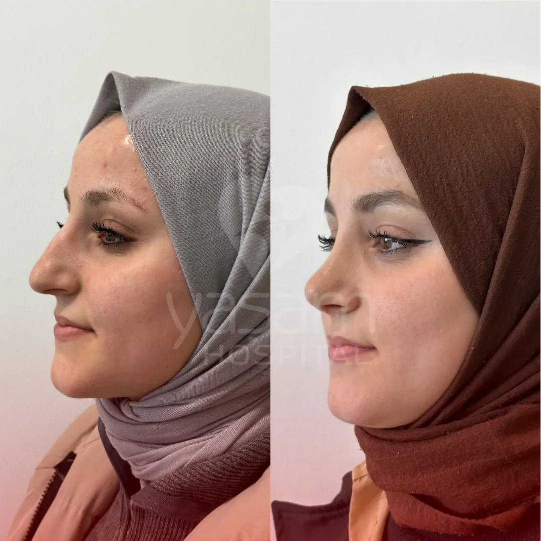 RHINOPLASTY