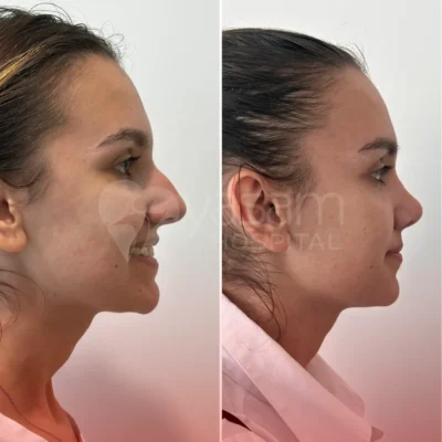 Rhinoplasty