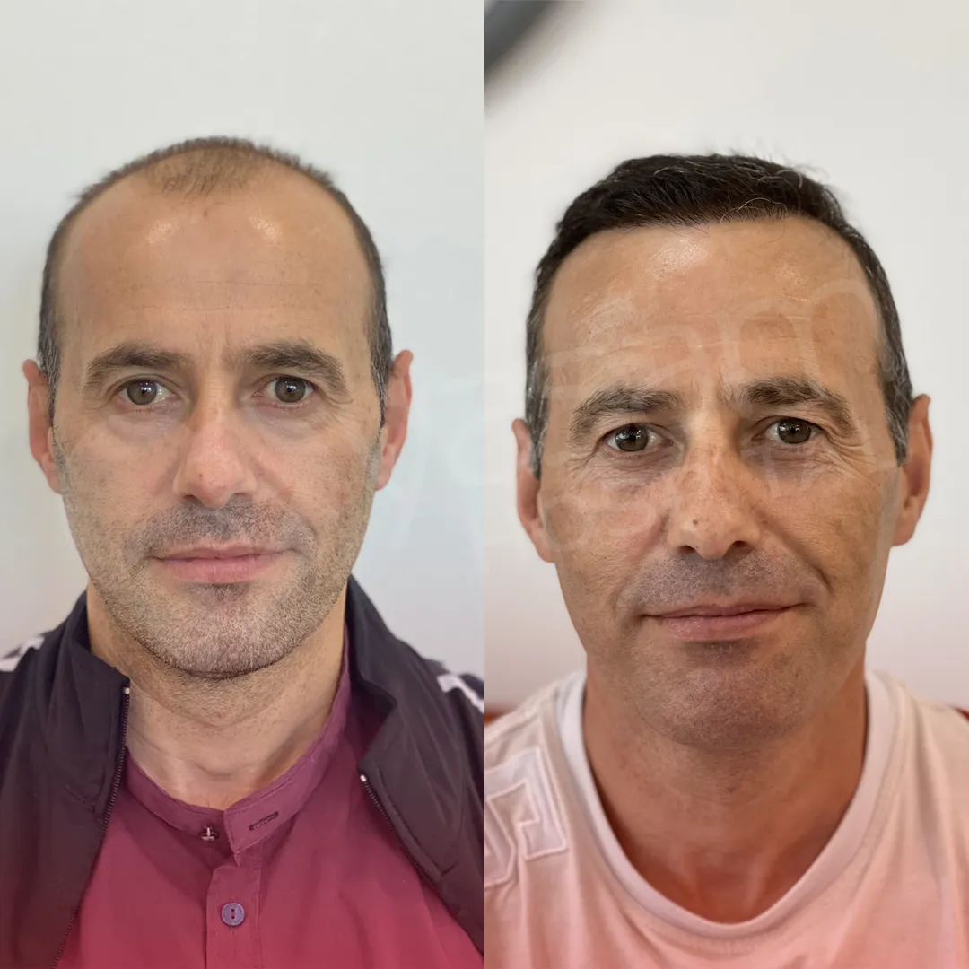 HAIR TRANSPLANT