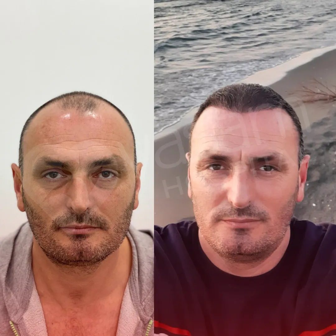Before & After