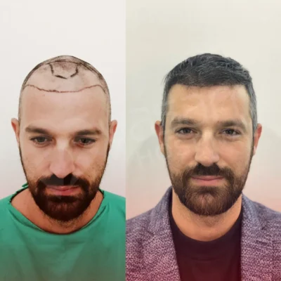 Hair Transplant