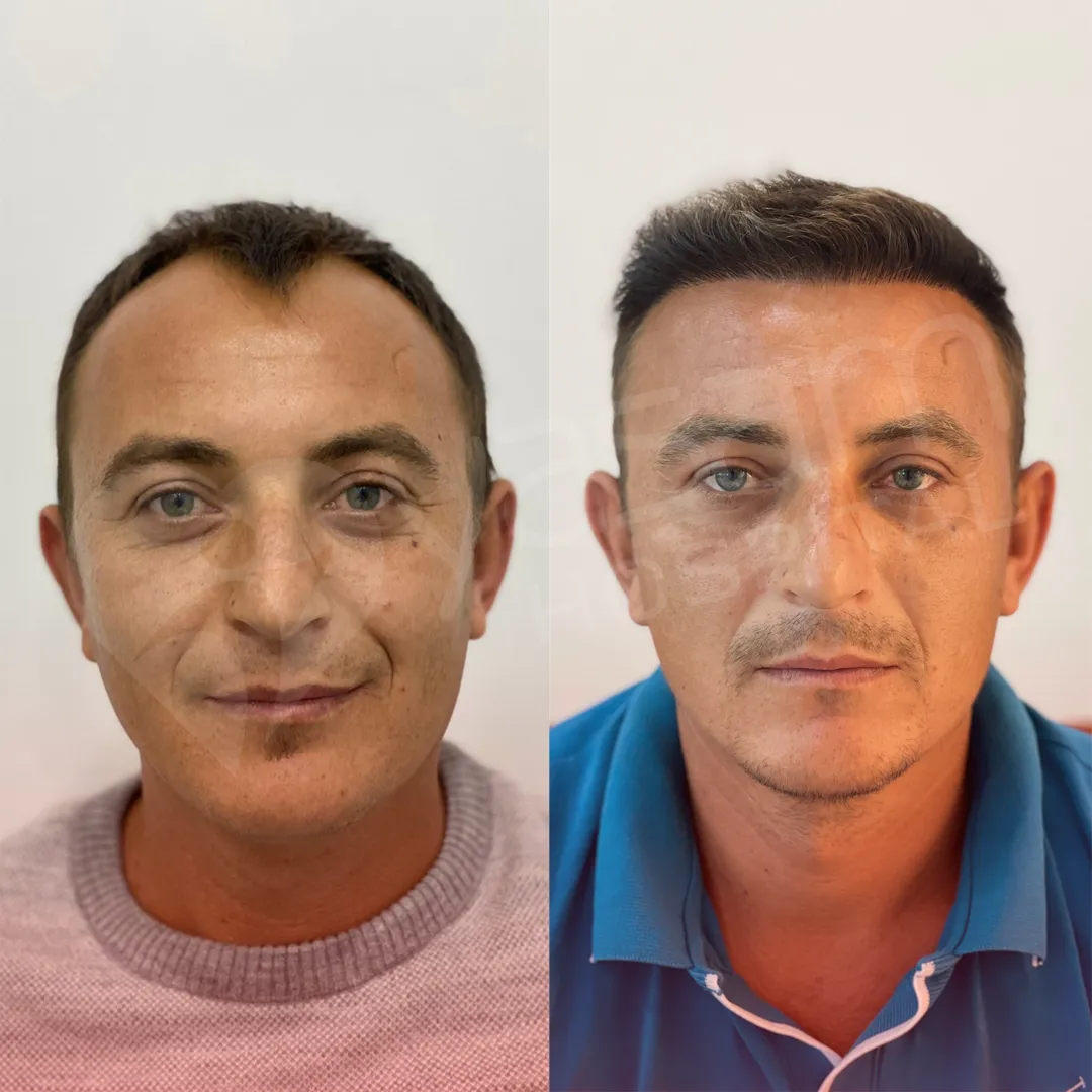 Before & After