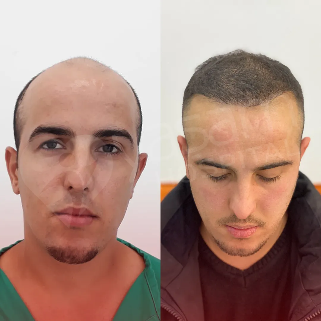 Before & After