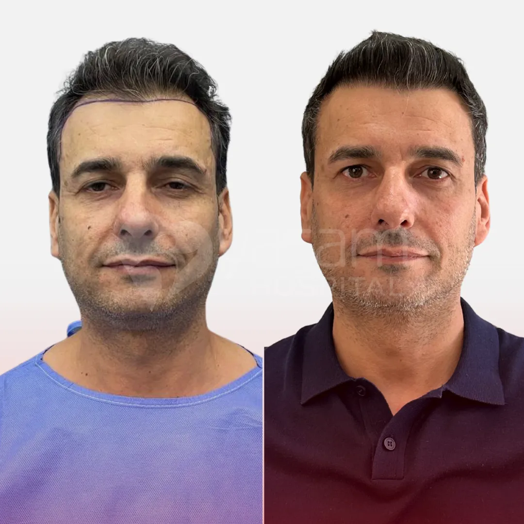 Before & After