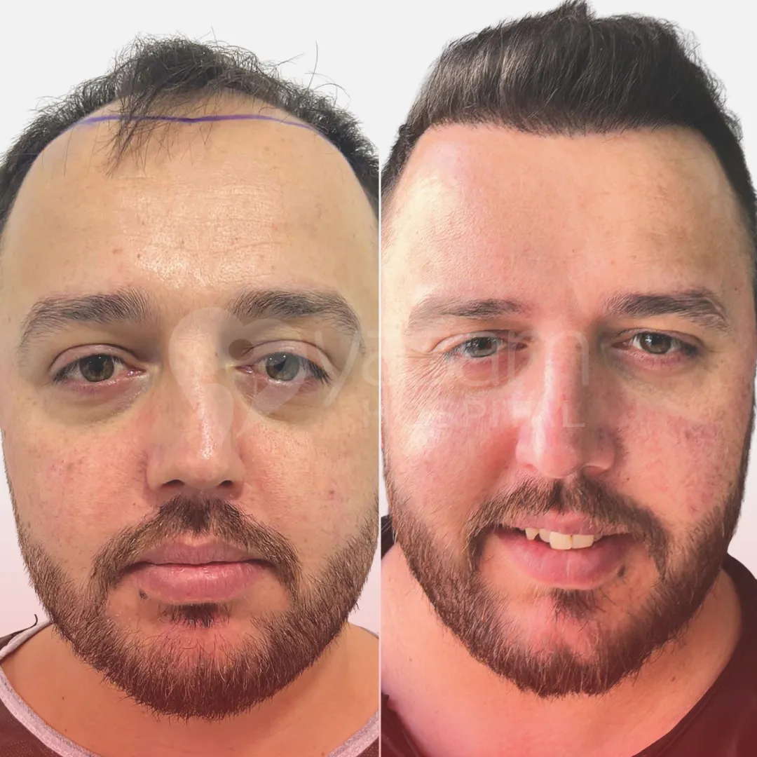 Before & After
