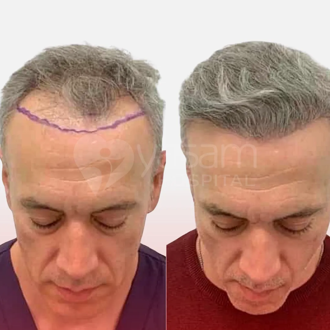 Before & After