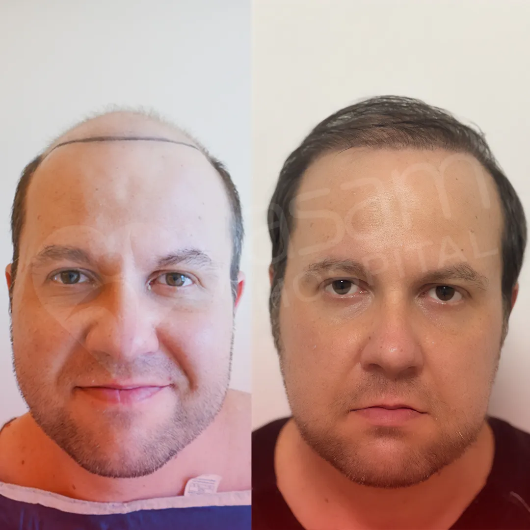 Before & After