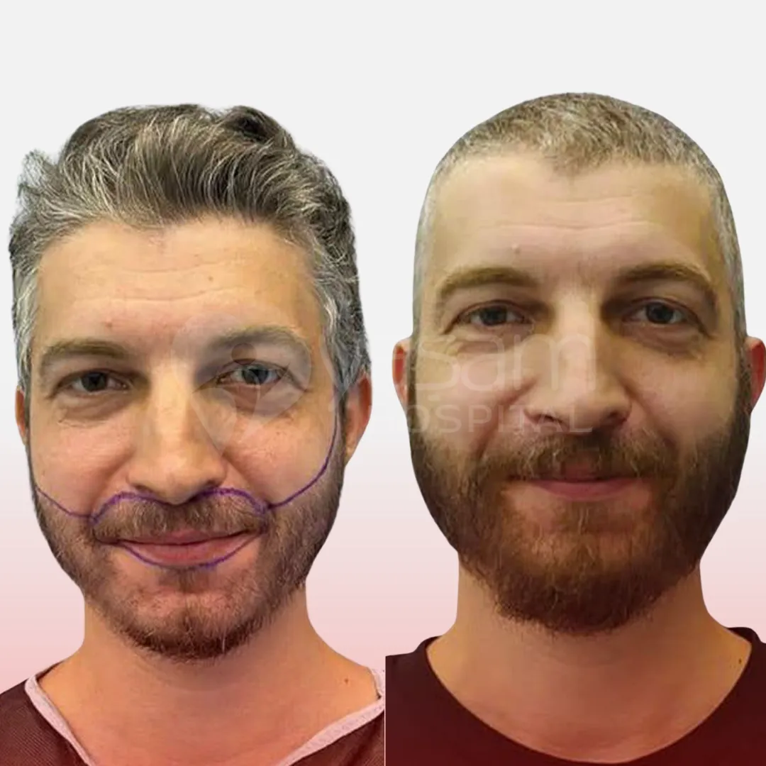 Before & After