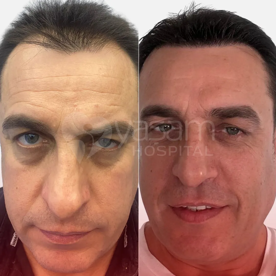 Before & After
