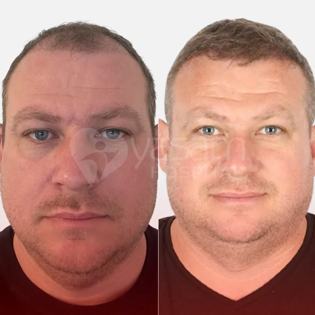 Before & After