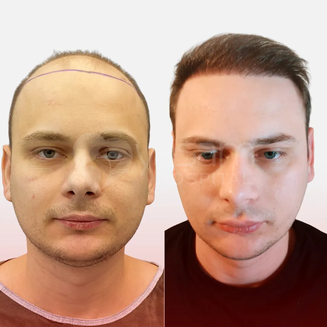 Before & After