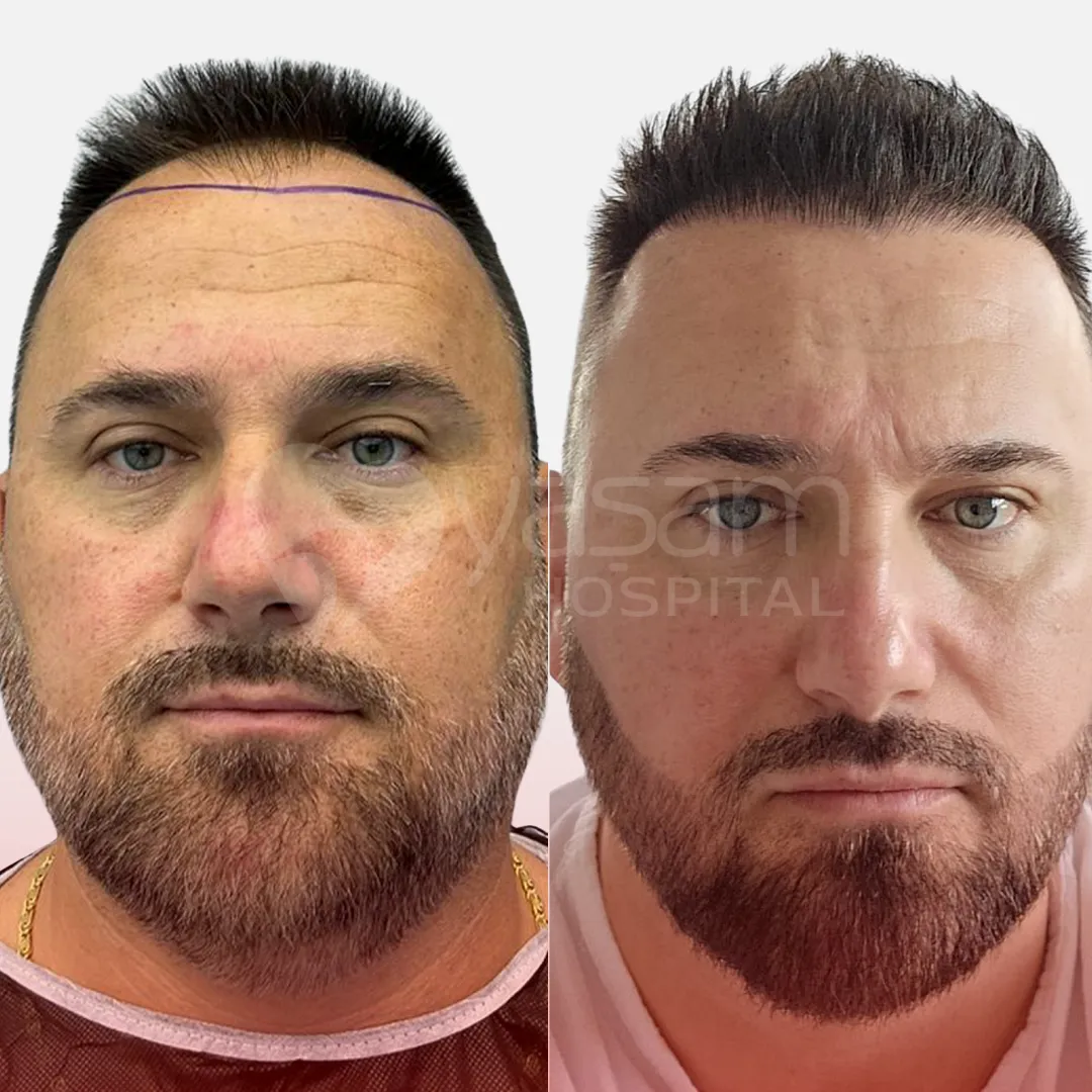 Before & After