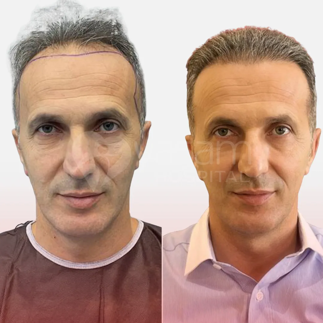 Before & After