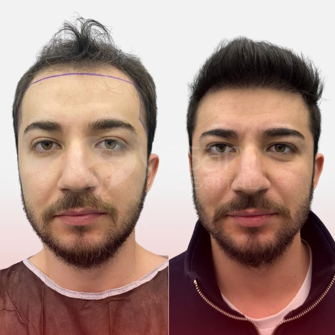 Before & After