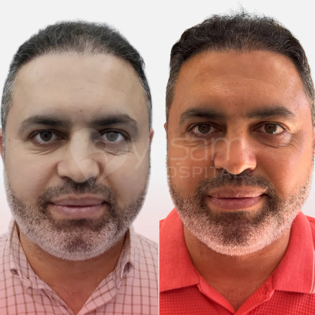 Before & After
