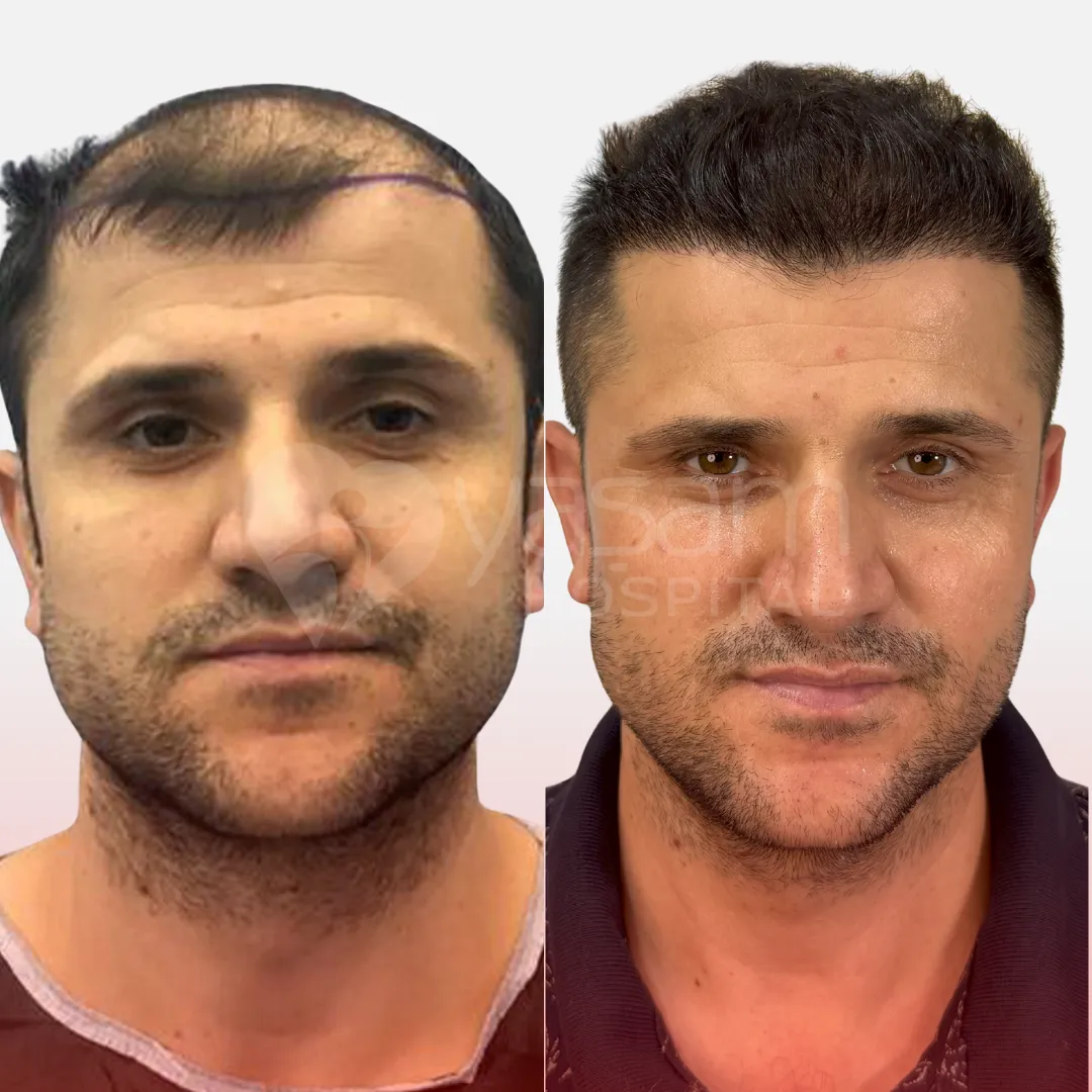 Before & After