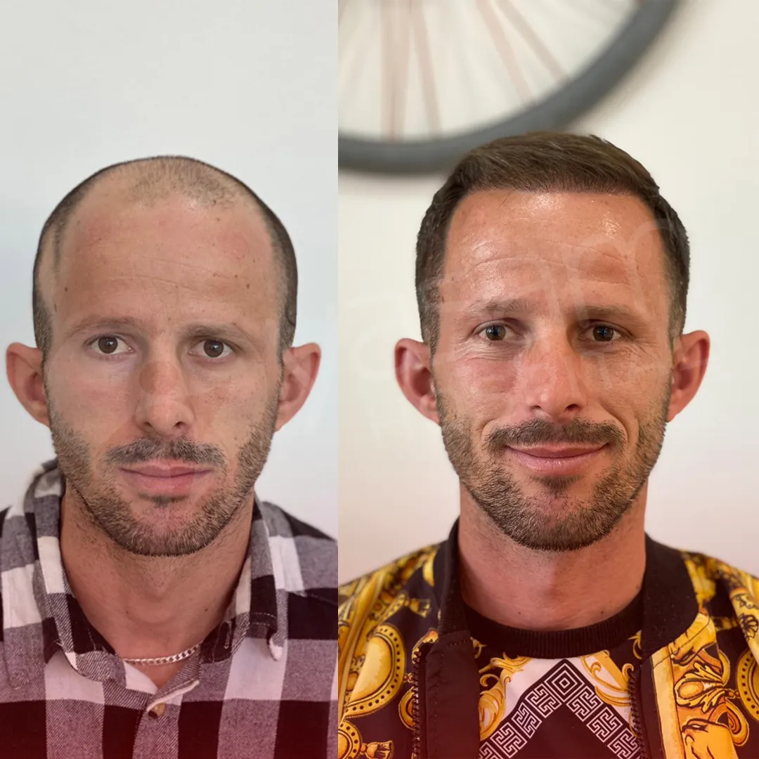 Before & After