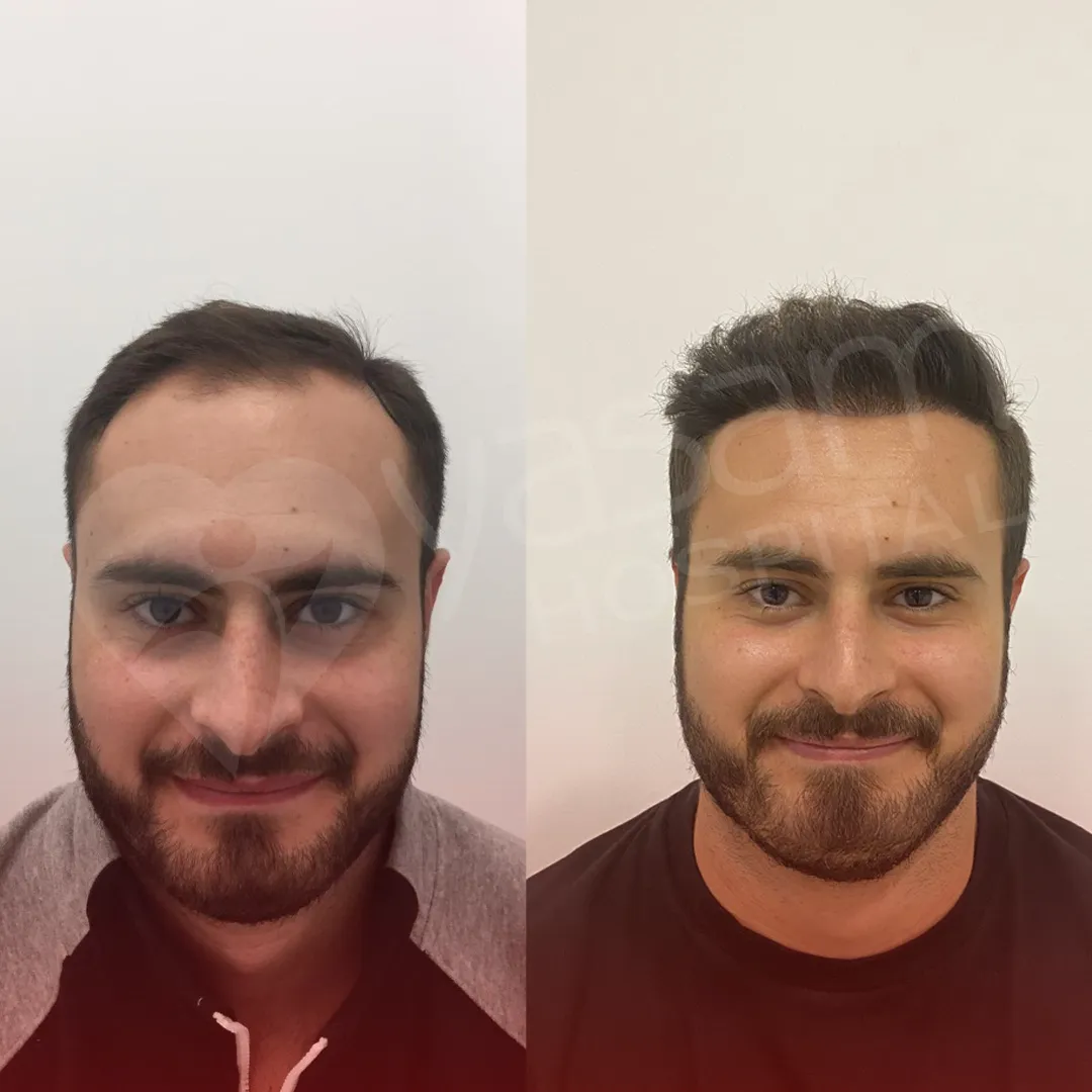 Before & After