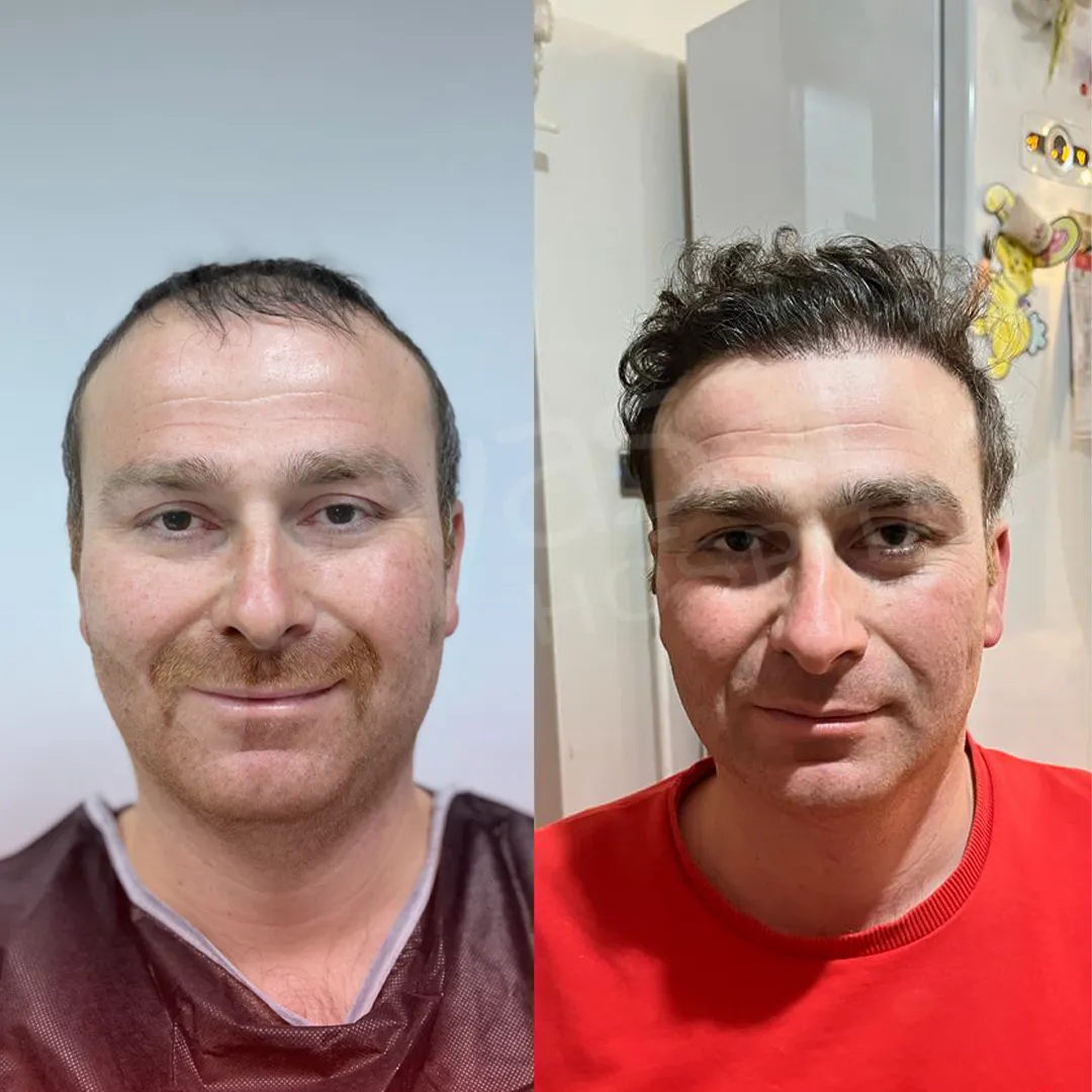 Before & After