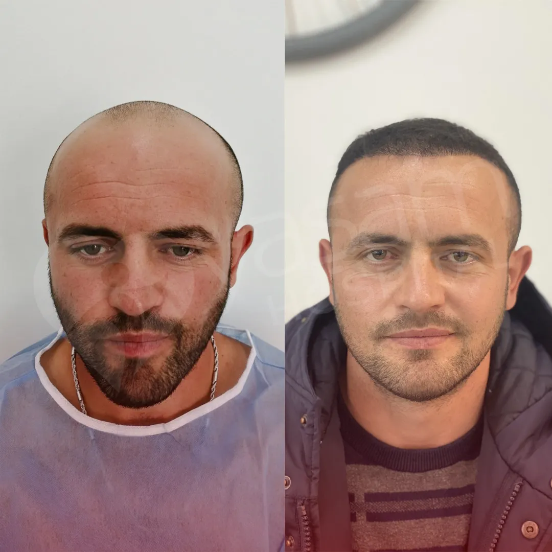 Before & After