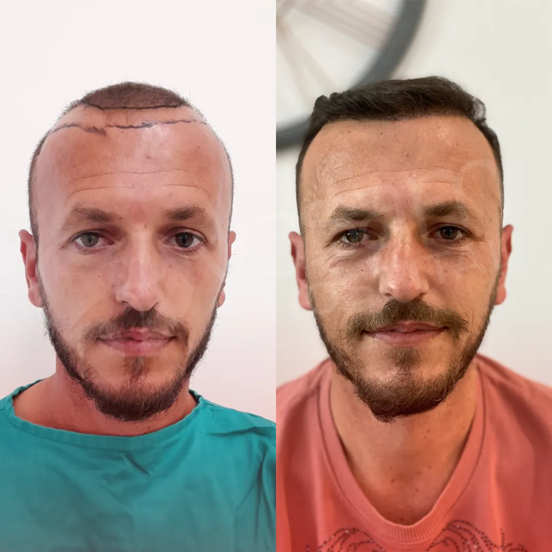 Before & After