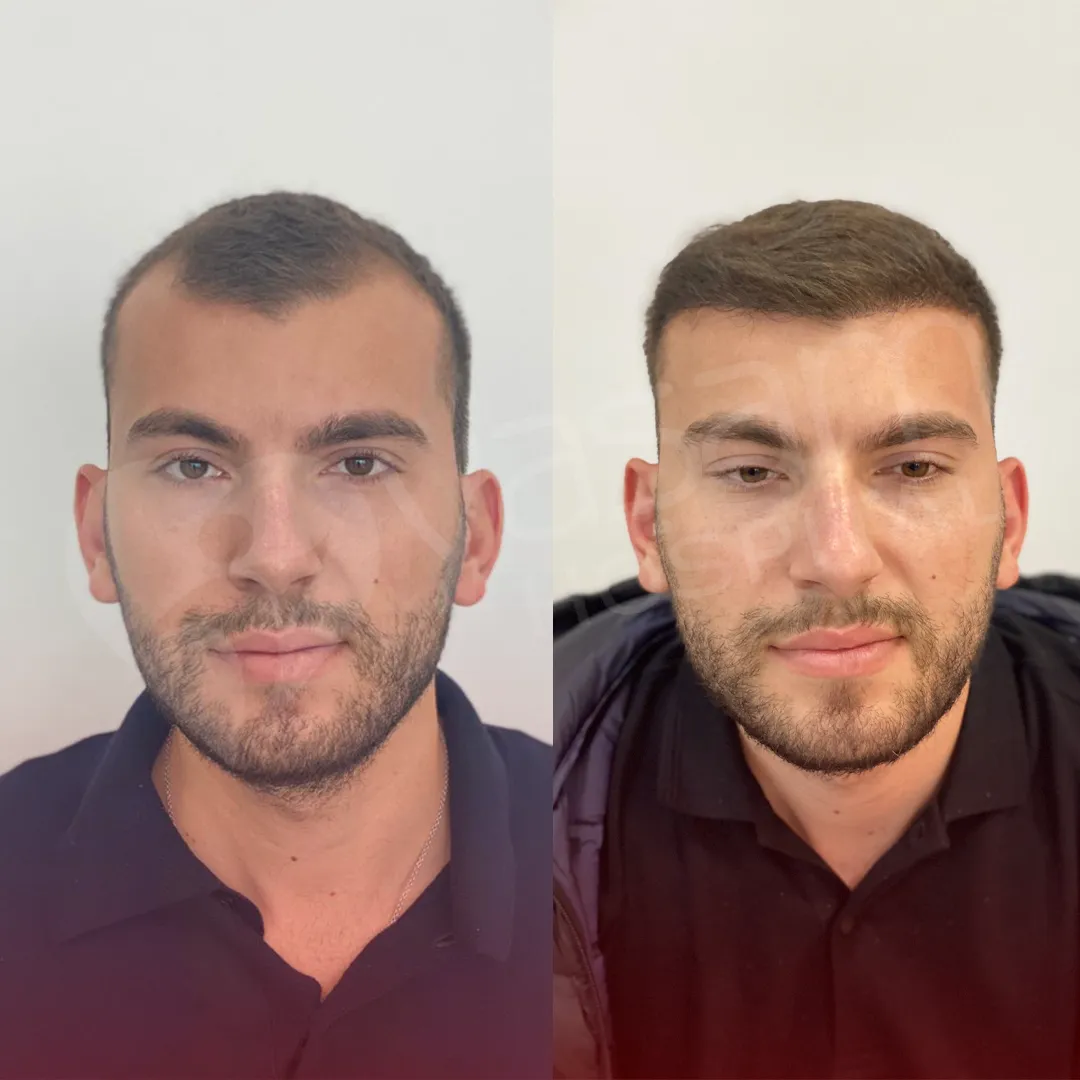 Before & After